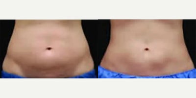 Woman treated with CoolSculpting - Woman treated with CoolSculpting. Patient is shown before and 12 weeks after second treatment.