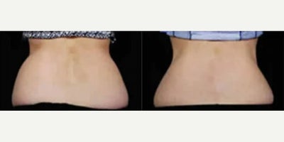 Woman treated with CoolSculpting - Woman treated with CoolSculpting. Patient is shown before and 10 weeks after treatment.
