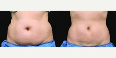 Woman treated with CoolSculpting - Woman treated with CoolSculpting. Patient is shown before and 8 weeks after treatment.