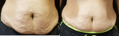 35-44 year old woman treated with Velashape - 3 Treatments