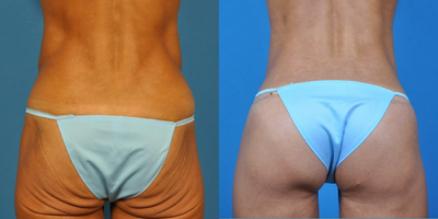 25-34 year old woman treated with Auto-Augmentation of the buttox - Healthy, athletic 40 y/o woman who lost significant weight through exercise and proper eating. She is a fitness model and had success in international competition. With weight loss, she loss buttock volume. A bilateral hipplasty and auto augmentation was performed.