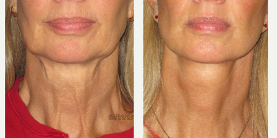 55 year old woman treated with Minilift - This attractive woman had been aging quite well other than disproportional aging of her neck and jawline.  After thorough consultation and evaluation we decided together to perform a modified lower facelift and necklift (a.k.a. a minilift).  The muscles (platysma and SMAS) of her neck and jawline were pulled tight via conservative incisions around the contour of her ear.