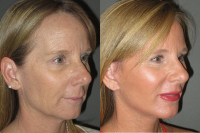 45-54 year old woman treated with CO2 Fractional Laser - In addition to other facial procedures (facelift, lip and chin augmentation), this patient wished for improvement of her skin texture, tone, and fine lines/wrinkles.  We treated her with the Lutronic eCO2 fractional laser (one treatment only on day of her other procedures).  Her recovery was about a week, and then was mildly pink for two additional weeks (she was allowed to use makeup).  Her skin, and results, continued to improve for about 6 months after the procedure as new collagen formed and skin contracture occurred.  Her procedure was safely performed under local anesthesia with oral sedation with valium in our office.