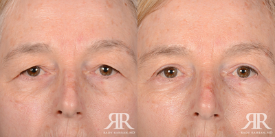 Brow Lift - Brow Lift