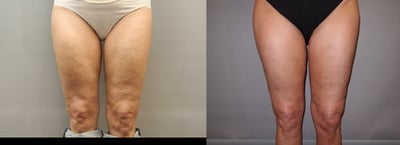 49 Year Old Female treated for Cellulite Reduction - Cellulaze - 
	49 Year old female with cellulite who was interested in improving the appearance of her thighs.Laser Cellulite Reduction
