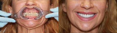 50 year old Patient treated with the All-on-4 Dental Implant Procedure - 50 year old Patient treated with severe priodontitis treated with the All-on-4 dental implant Procedure
