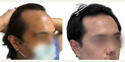 25-34 year old man treated with Rogaine - This is a 29-year-old male patient who came to us with a 4-year history of hair loss, with a significant recession of his frontal and temporal (side) hairlines. This resulted in the appearance of deep recessions that, even before age 30, were extending well behind his ears.Hed already started finasteride about a year before his surgery and noticed that his hair loss had stopped. He had no side effects from this medication.We did an 1800 graft FUE procedure to advance his frontal hairline only, which effectively brings it down along the sides to improve the deep recessions. He didnt want to bring the temporal (side) hairlines forward just in case he had future recession in that area behind the transplanted hair. His result (shown at 1-year post-op)! Even though we only advance the frontal hairline by about 1cm (as seen on the surgical markings), you can see from the photo markings that his hairline was brought significantly closer to his eyes, and the frontal-temporal points are now well ahead of his ears, instead of behind them. The overall result is very natural and very masculine looking, and is sure to continue to be well into the decades ahead. Immediately following his surgery he was also started on high-strength topical minoxidil to further enhance his surgical result, and this patient is continuing on that combination of finasteride and minoxidil to keep his hair looking great for decades to come.