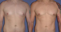 Gynecomastia / Male Breast Reduction - Gynecomastia or male breast reduction corrects the over-developed or enlarged breasts of men. Breast Reduction is done under general anesthesia. Incisions are made around the pigmented area (the nipple areolar complex) and extend vertically below the nipple and in the fold under the breast. The nipple areolar complex is moved upward to the desired location, while excess breast tissue, skin, and fat are removed.