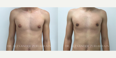 Man treated with Gynecomastia Surgery - Man treated with Gynecomastia Surgery