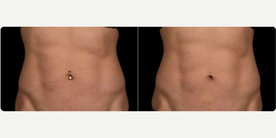 Woman treated with truFlex - Woman treated with Secret RF.