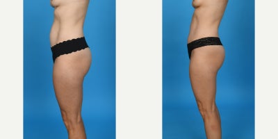 35-44 year old woman treated with Abdominal Etching, Diastasis Recti Repair, Drainless Tummy Tuck, Liposculpture, Liposuction, M - Standard tummy tuck with VASER ultrasound liposuction 360 and corset muscle plication.