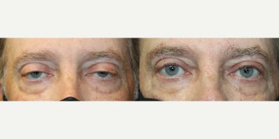 55-64 year old man treated with Ptosis Surgery - 55-64 year old man treated with Ptosis Surgery