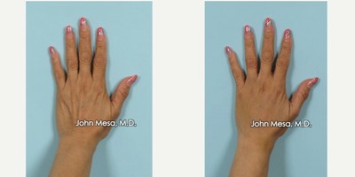 45-54 year old woman treated with Radiesse + for Hand rejuvenation - 45-54 year old woman treated with Radiesse + for Hand rejuvenation.
1 and 1/2 syringes of radiesse + per hand.
Left Hand