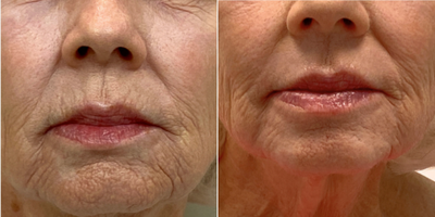 Woman treated with Microdermabrasion - Skin Resurfacing (Perioral dermabrasion)