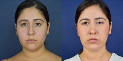 25-34 year old woman treated with Neck Lift, Power-Assisted Liposuction (PAL), Buccal Fat Removal, Chin Implant, Chin Liposuctio - This female patient treated with Deep Necklift ( platysmal and digastric muscle plication and lift ) buccal fat removal and facial lipo. She has a jowl line reshaping and more facial definition and dual plane anatomical chin implant.