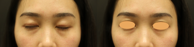 18-24 year old woman treated with Eyelid Surgery - 18-24 year old woman treated with an Asian Upper Eyelid Surgery (also known as an Upper Asian Blepharoplasty.)