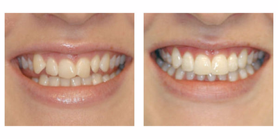 Crowded teeth treated with Clear Braces - A 46 year old woman with crowded teeth. Patient was treated with clear braces and NiTi wires in 6 months. Patient received bonded upper and lower retainers
