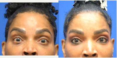 55-64 year old woman treated with Daxxify - Improved frown lines/ glabella and forehead