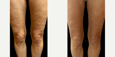 Woman treated with Sylfirm X - Woman treated with Sylfirm X