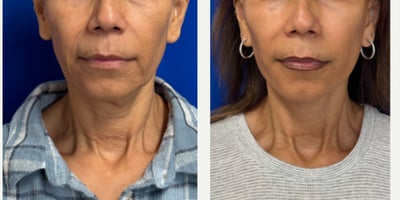 64 year old woman treated with Facelift - 64 year old woman treated with Facelift under IV sedation.