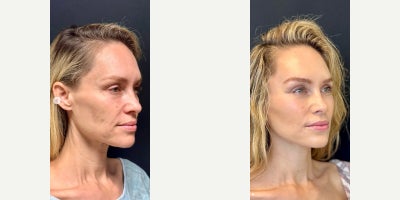 Woman treated with Facial Fat Transfer - My beautiful, beautiful patient. She was gorgeous before and all we did was my DEFINE LIFT. A Deeplane Extended Facelift Including Necklift, the Elevation of the brows, and a touch of fat transfer. You can see she looks like herself just rejuvenated. My goal with facelift rejuvenation is always to try to make the patient a little more prettier or handsome. It's never meant to change the way they look. I think we nailed it! No one can tell what she had done other than she looks gorgeous!
