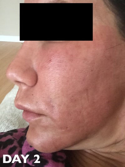 43 Years Old Resurfacing Acne Scares Wrinkles Review Realself