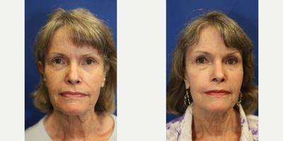 65-74 year old woman treated with TCA Peel - Dr. Katzen used a TCA chemical peel to treat the discoloration of this patient's face.
