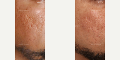 Acne Scars Combination Treatment by Dr. Qazi - Acne Scars Combination Treatment with TCA Cross + Subcision + Bellafill.