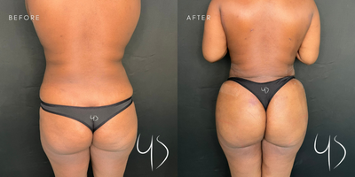 35-44 year old woman treated with Brazilian Butt Lift - Brazilian Butt lift or BBL Operation is a surgical procedure in which fat is removed from other parts of your body and attached to the butt. BBL surgery is mostly done to enhance your lower bodys curves and provide a more proportionate look. It also reduces the fat from areas like thighs and hips and enhances the look of the buttocks.Amazing Brazilian Butt Lift post-op 5 days result from our lovely patient.