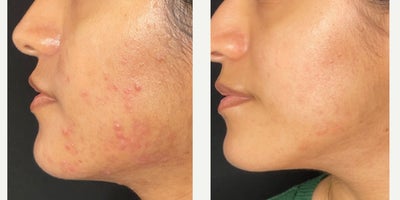 Healing Acne - Treating acne and hyperpigmentation from acne using a medical grade skincare routine and a series of chemical peels