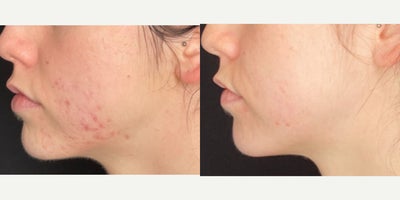Treating Acne, Acne Scarring, and Discoloration/Hyperpigmentation - Acne and acne scarring progression using curated medical grade skincare in a comprehensive skincare routine, and a series of chemical peels