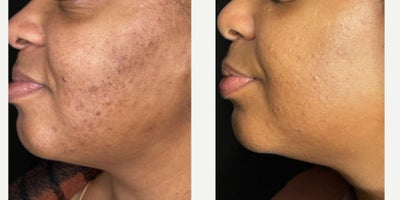 Treating Acne, Acne Scarring, and Discoloration/Hyperpigmentation - Acne and acne scarring progression using curated medical grade skincare in a comprehensive skincare routine, and a series of chemical peels