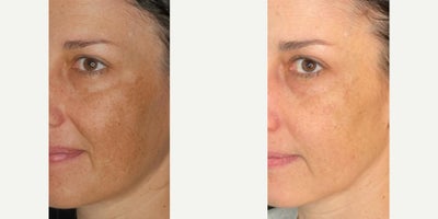25-34 year old woman treated with Chemical Peel, Glycolic Peel, Skinbetter Science, Alastin Skincare - Treating hyperpigmentation from melasma using a series of chemical peels and establishing a medical grade skincare routine