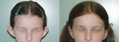 otoplasty/ear set back - 
	performed under local anesthesia
