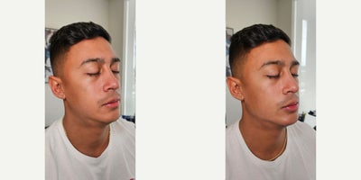 25-34 year old man treated with Dermal Fillers - Jawline and chin filler