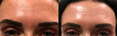 45-54 year old woman treated with Laser Treatment - Before and after 2 Picosure focus laser treatments. No down time!