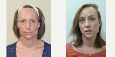 45-54 year old woman treated with Facial Feminization Surgery - Patient had Facial Feminization surgery to soften the features of the face.