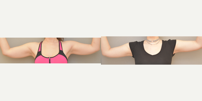 34 year old woman treated with Laser Liposuction of Arms - Smartlipo arms