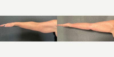 Woman treated with Vaser Liposuction - Woman treated with Vaser Liposuction- 6 months post-op