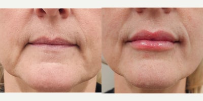 45-54 year old woman treated with Lip Fillers, Revanesse, Restylane - Needed Lip Renaissance with natural results