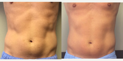 25-34 year old man treated with truSculpt flex - Before and after 3 truSculpt flex treatments. (Recommendation is to do a total of 6 treatments.)