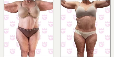 Woman treated with Lipo 360 - Woman treated with Lipo 360.