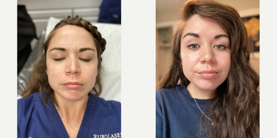 25-34 year old woman treated with Aquagold - Client was wanting to address overall skin rejuvenation and dull skin. Client received Aquagold Ultimate Radiance Serum + Vitamin C cocktail. This high performance serum also includes Sterilized Hyaluronic Acid, Copper Tripeptide-1, PDRN and Growth Factors.
