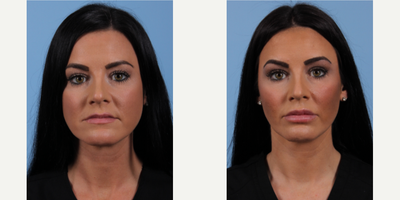 35-44 year old woman treated with Revanesse - A 35 year old woman came to the office of Dr. Suzanne Yee to discuss dermal fillers.  Dr. Yee injected the patients cheeks, nasolabial folds, and lips with the RHA Collection of dermal fillers.  The patient is very pleased with her results.