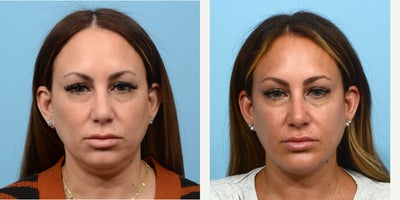 35-44 year old woman treated with Chin Surgery - Seeking to get rid of her dreaded double chin, this patient turned to Dr. Wise. He recommended a combination treatment of both submental liposuction and a chin implant, to give her facial features a natural-looking balance. Seven weeks post-op, the patient loves her new side profile and the gorgeous definition of her chin and jawline.