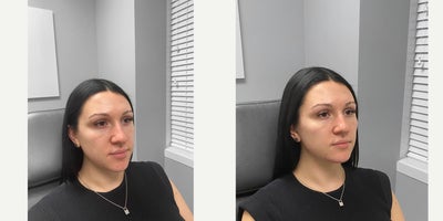 25-34 year old woman treated with Chin Filler - Looking to subtly add more definition to her cheeks and jawline, this patient opted for dermal fillers. After photos were taken immediately following treatment.