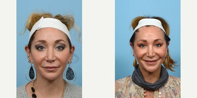 35-44 year old woman treated with Earfold - otoplasty