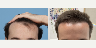 22 year old man treated with Hair Transplant - Follicular Unit Extraction Hair Transplant