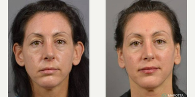 Woman treated with Ear Surgery - Procedure: OtoplastySurgeon: Dr. MarottaPatient Goal: Eliminate protruding ears