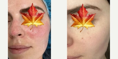 Woman treated with Skin Rejuvenation - Rosacea can be treated with topical prescription medications such as Azelex, Metrogel, Sulfacet R & more.Once the condition is under control the underlying & deeper blood vessels can be treated using Diolite laser & IPL photofacial. 3 or 4 sessions over 2 months are usually needed to significantly reduce redness & tighten pores. Results last for years.